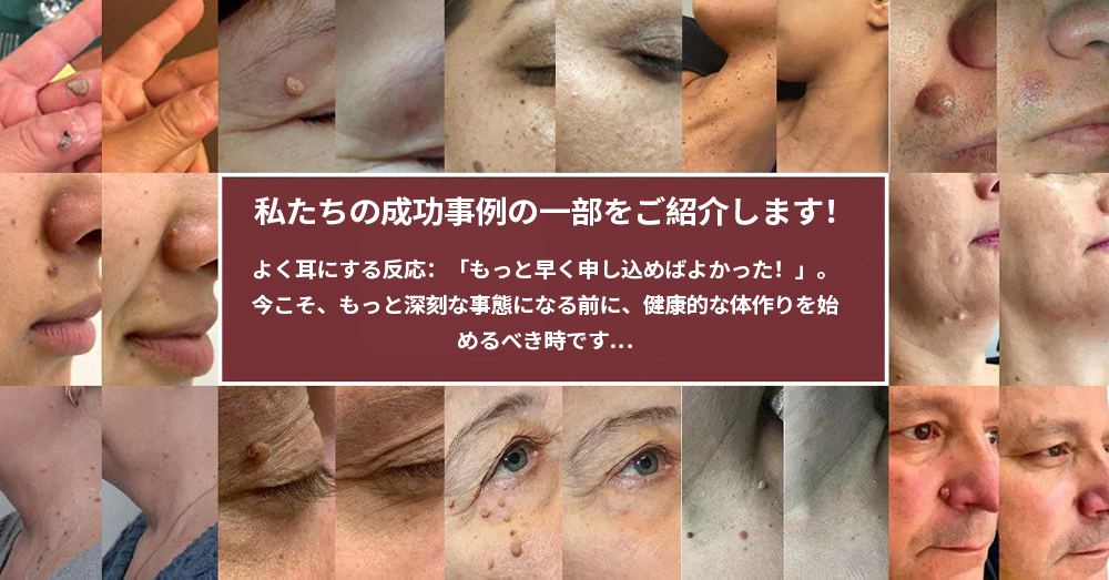 🔥Curalona® 2-in-1 マイクロニードル＆ハイドロコロイドパッチ | 🔥隆起したほくろ、ニキビ、扁平イボ、皮膚線維腫を除去 | シワ、傷跡、肌の気になる部分の改善をサポート | 顔や体に使える目立たないパッチ