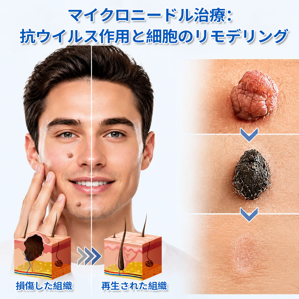 🔥Curalona® 2-in-1 マイクロニードル＆ハイドロコロイドパッチ | 🔥隆起したほくろ、ニキビ、扁平イボ、皮膚線維腫を除去 | シワ、傷跡、肌の気になる部分の改善をサポート | 顔や体に使える目立たないパッチ