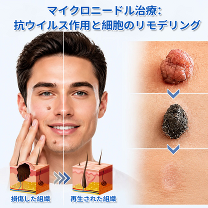 🔥Curalona® 2-in-1 マイクロニードル＆ハイドロコロイドパッチ | 🔥隆起したほくろ、ニキビ、扁平イボ、皮膚線維腫を除去 | シワ、傷跡、肌の気になる部分の改善をサポート | 顔や体に使える目立たないパッチ